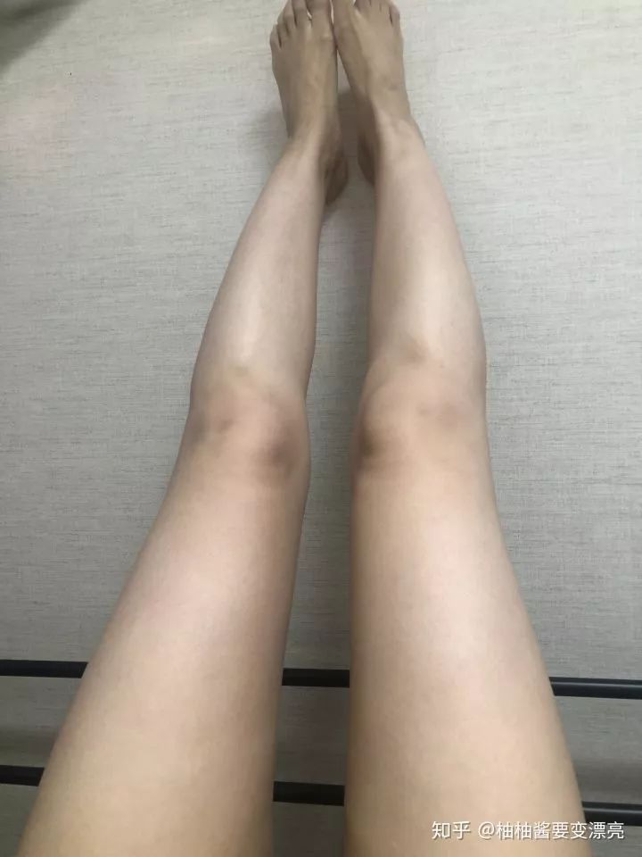 抽脂经历分享：术前术后腿围变化及复胖情况，快来加油