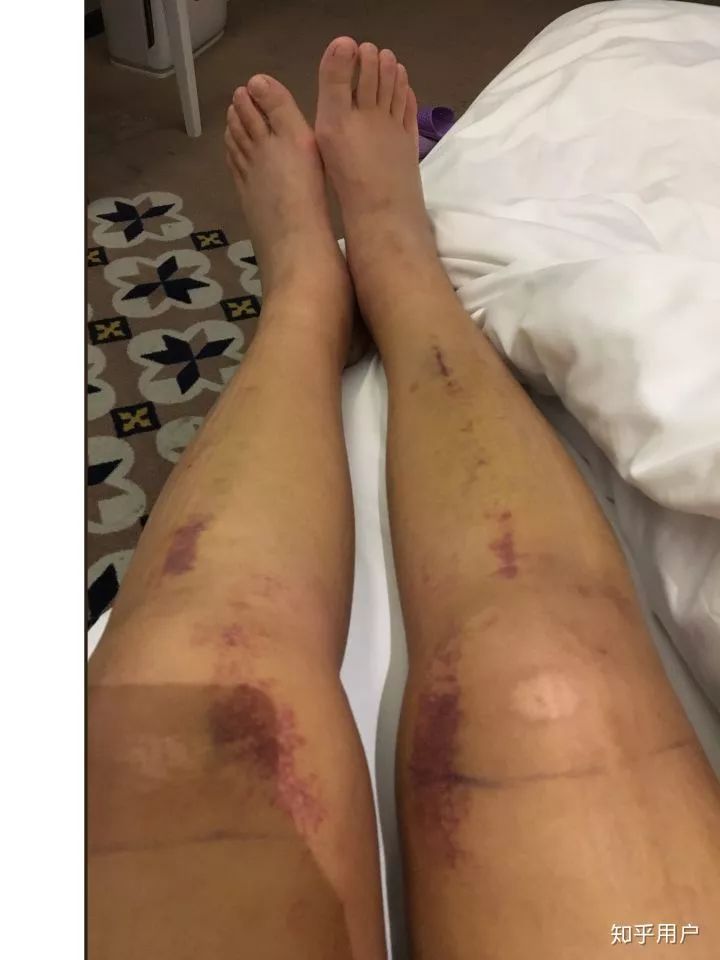 反弹腿抽脂会小肚子吗_反弹腿抽脂会小腿变粗吗_小腿抽脂会反弹吗