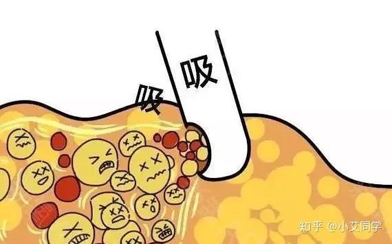 反弹腿抽脂会小腿变粗吗_反弹腿抽脂会小肚子吗_小腿抽脂会反弹吗