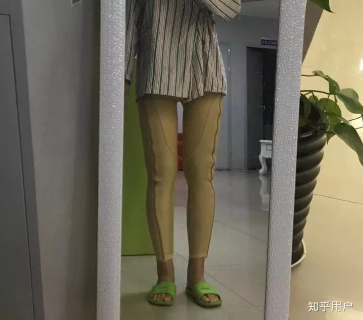 反弹腿抽脂会小腿变粗吗_小腿抽脂会反弹吗_反弹腿抽脂会小肚子吗