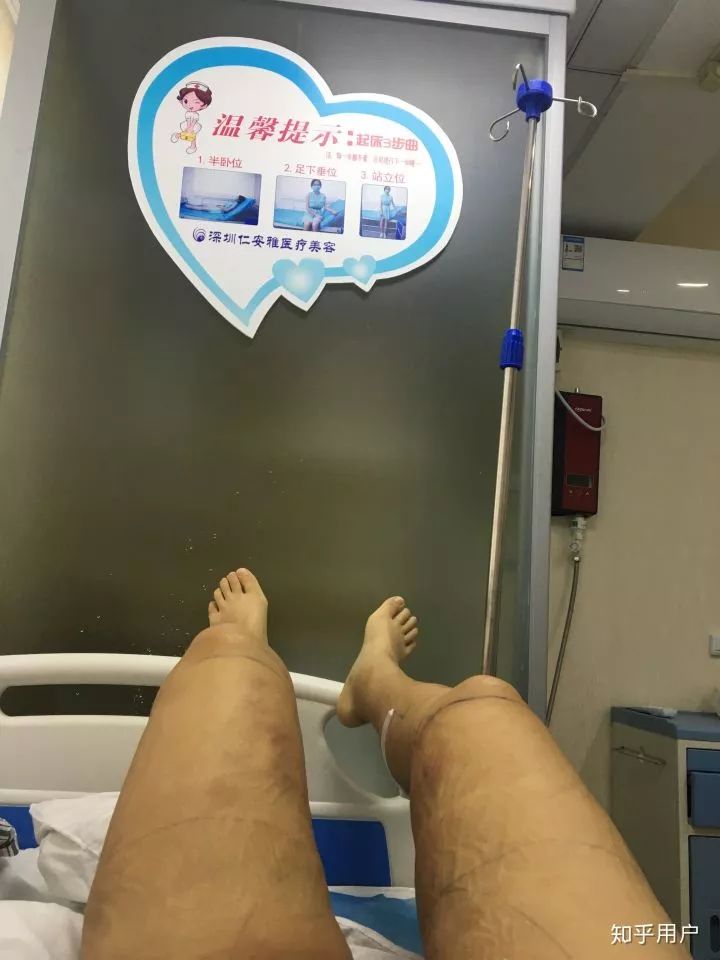 小腿抽脂会反弹吗_反弹腿抽脂会小腿变粗吗_反弹腿抽脂会小肚子吗