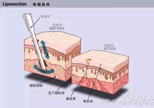 反弹腿抽脂会小腿变粗吗_腿部抽脂反弹后会更粗吗_小腿抽脂会反弹吗