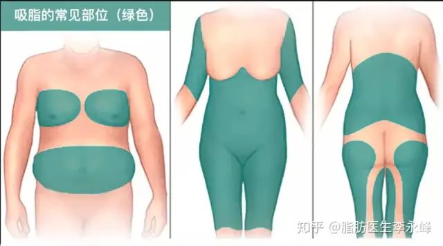 腿部抽脂反弹后会更粗吗_反弹腿抽脂会小腿变粗吗_小腿抽脂会反弹吗